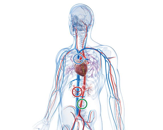 Chemotherapy Port 20 G - Plastic- IN-PORT - A COMPLETE RANGE OF ACCESS PORTS  at best price in Chennai